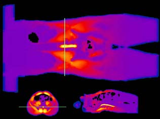 temperature distribution induced by a Sigma-60 hyperthermia applicator.